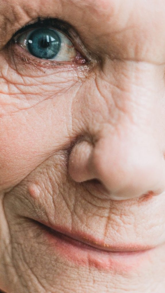 Tratamiento arrugas peribucales en Getxo