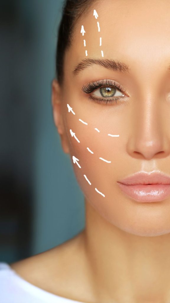 Tratamiento con hilos tensores en Getxo